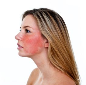 home-remedies-for-rosacea
