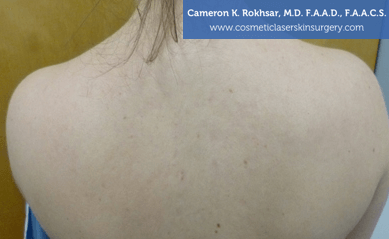V-Beam Laser After Treatment Photo - patient 4