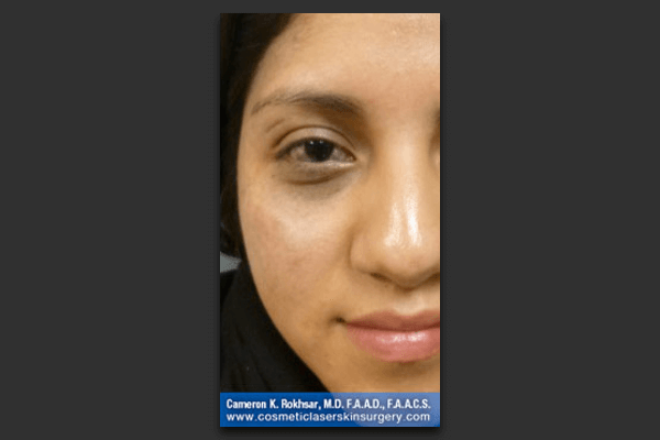 Age/Brown Spots - After Treatment Photo: female, front view, patient 3