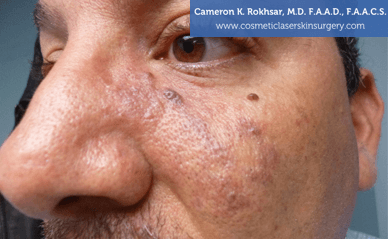 Birthmarks. After treatment photo - male, oblique  view, patient 3