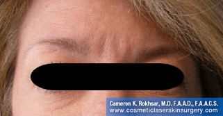 Botox. After Treatment photo, front view, female patient 8