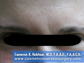 Botox. After Treatment photo, front view, male patient 3