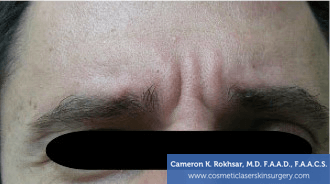 Botox. Before Treatment photo, front view, male patient 6