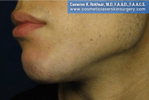Non-Surgical Chin Job - After Treatment photo, male - left side view, patient 6