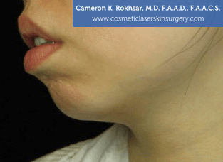 Non-Surgical Chin Job - Before Treatment photo, female - left side view, patient 9
