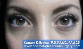 Non-Surgical Eye Lift. After Treatment Photo - front view, female patient 9