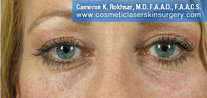 Non-Surgical Eye Lift. After Treatment Photo - front view, female patient 10