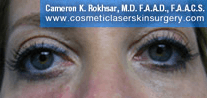 Non-Surgical Eye Lift. After Treatment Photo - front view, female patient 11