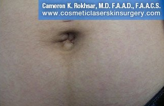 Patient tummy, After Fraxel Treatment photo: restore stretch marks, front view - patient 37