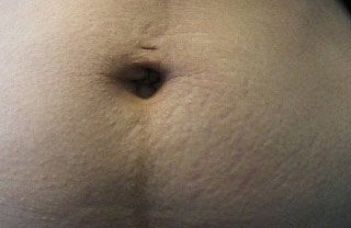 Patient tummy, Before Fraxel Treatment photo: restore stretch marks, front view - patient 37