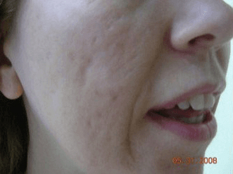 Fraxel - Before Treatment photo, female,right side view - patient 16