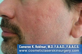 Male face, After Fraxel Treatment photo, restore cheek - left side, oblique view - patient 1