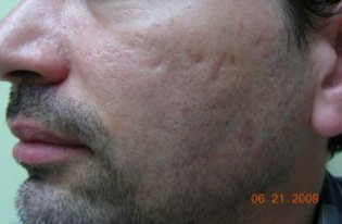 Male face, Before Fraxel Treatment photo, restore cheek - left side, oblique view - patient 1