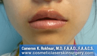 Lip Enhancement - After Treatment Photo, front view - female patient 5