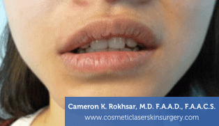Lip Enhancement - Before Treatment Photo, front view - female patient 5