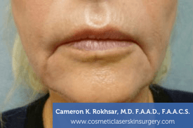 Lip Enhancement - Before Treatment Photo - patient 4