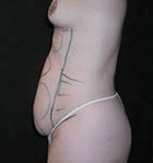 Liposculpture Liposuction - Before Treatment photos, left side view, female patient 13