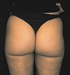 Liposuction - After Treatment Photos, legs, back view - female patient 10
