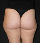 Liposuction - Before Treatment Photos, legs, back view - female patient 10