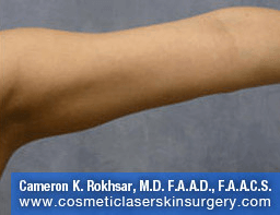 Liposculpture Liposuction - After Treatment photos, front view, female hand, patient 15