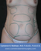 Liposculpture Liposuction - Before Treatment photo, front view, female patient 12