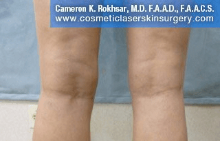 Liposuction - After Treatment Photos, legs, back view - female patient 9