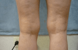Liposuction - Before Treatment Photos, legs, back view - female patient 9