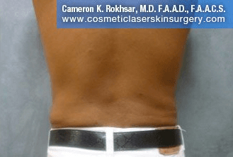 Liposuction - After Treatment Photos, back view - female patient 8