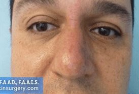 Non Surgical Nosejob - After treatment photo, male, front view, patient