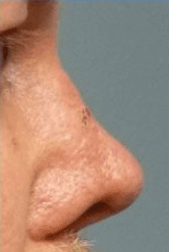 Non Surgical Nosejob - After treatment photo, male, right side view, patient 40