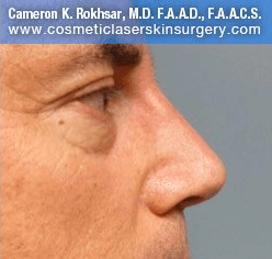 Non Surgical Nosejob - After treatment photo, male,right side view, patient 16