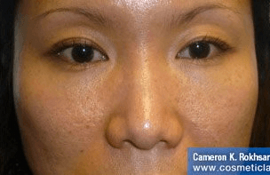 Non Surgical Nosejob - Before treatment photo, female, front view, patient 38