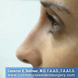 Non Surgical Nosejob - After treatment photo, female, left side view, patient 36