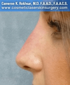 Non Surgical Nosejob - After treatment photo, female, left side view, patient 35