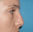 Non Surgical Nosejob - After treatment photo, female, right side view, patient 33