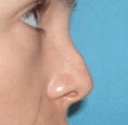 Non Surgical Nosejob - Before treatment photo, female, right side view, patient 33