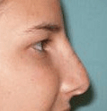 Non Surgical Nosejob - After treatment photo, female, right side view, patient 32