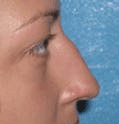 Non Surgical Nosejob - Before treatment photo, female, right side view, patient 31