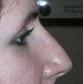 Non Surgical Nosejob - After treatment photo, female, right side view, patient 30