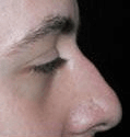 Non Surgical Nosejob - Before treatment photo, male, right side view, patient 48