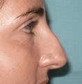 Non Surgical Nosejob - Before treatment photo, female, right side view, patient 27