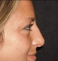 Non Surgical Nosejob - Before and After treatment photo, female, right side view, patient 25