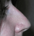 Non Surgical Nosejob - After treatment photo, female, right side view, patient 24