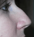 Non Surgical Nosejob - Before treatment photo, female, right side view, patient 24