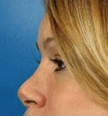 Non Surgical Nosejob - Beforetreatment photo,left side view, female patient 22