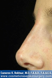 Fillers. After Treatment photos - female, left side view, patient 12