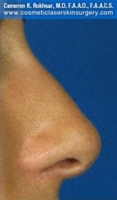 Fillers. After Treatment photos - female, right side view, patient 13