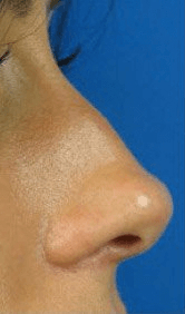 Fillers. Before Treatment photos - female, right side view, patient 13