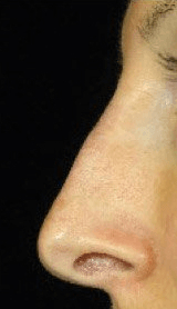 Fillers. After Treatment photos - female, left side view, patien