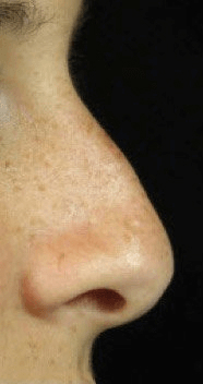 Fillers. Before Treatment photos - female, right side view, patient 18